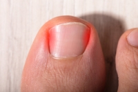 Ingrown Toenail Pain Should Not Be Ignored