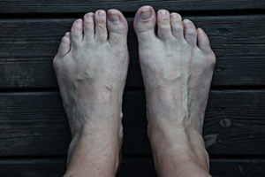 Definition and Causes of Bunionettes