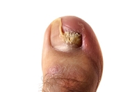 Toenail Fungus and Nail Polish