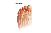 Common Symptoms of Morton’s Neuroma