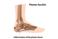 Definition and Risk Factors Explored for Plantar Fasciitis
