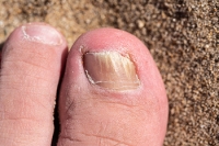 Managing a Fungal Toenail Infection